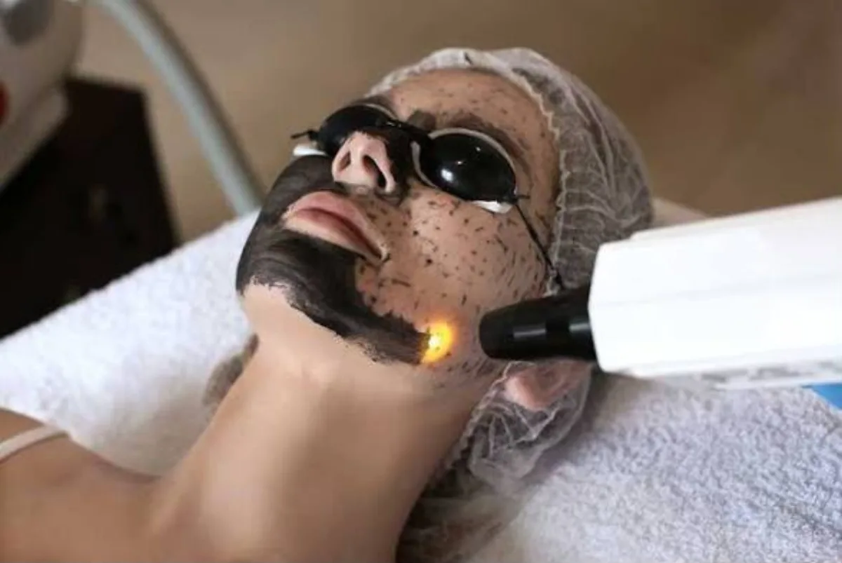 Carbon Peel
